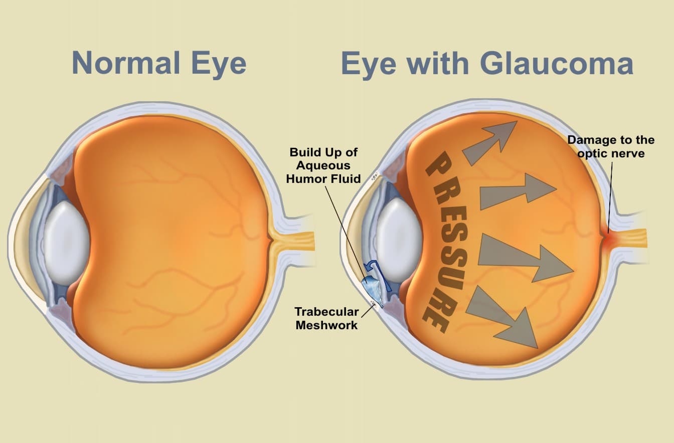 Glaucoma Management