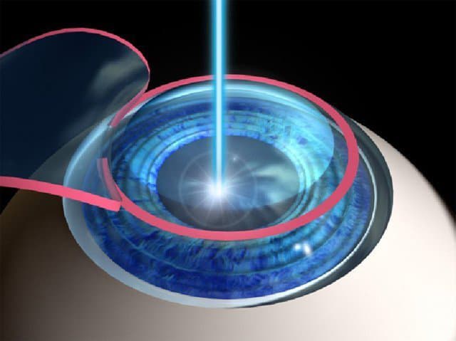 LASIK & Refractive