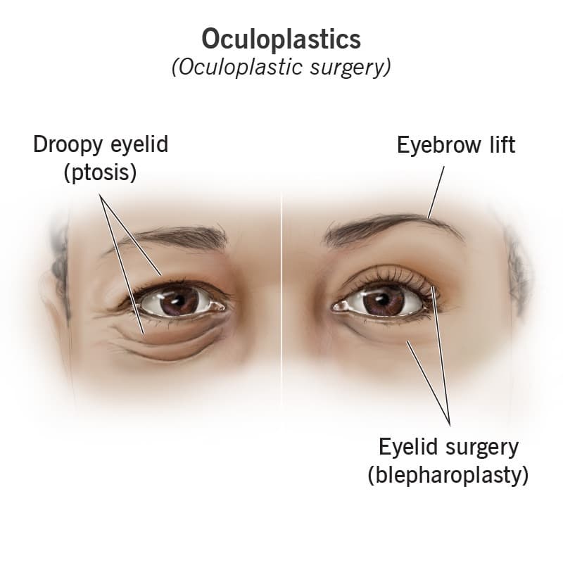 Oculoplasty